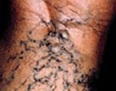 Spider Vein Removal Before & After Gallery - Patient 5884038 - Image 1