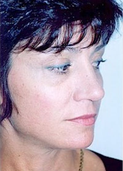 Rhinoplasty Before & After Gallery - Patient 5884041 - Image 2