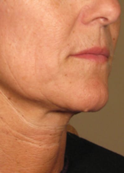 Ultherapy Gallery - Patient 5884039 - Image 2