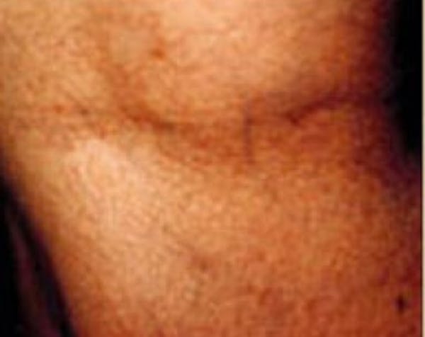 Spider Vein Removal Before & After Gallery - Patient 5884038 - Image 2