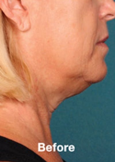 Kybella Before & After Gallery - Patient 5884040 - Image 1