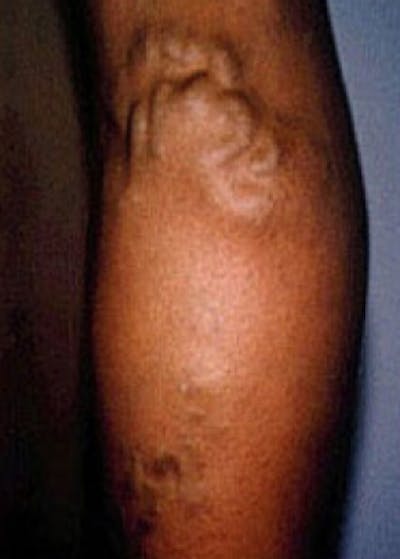 Spider Vein Removal Before & After Gallery - Patient 5884042 - Image 1