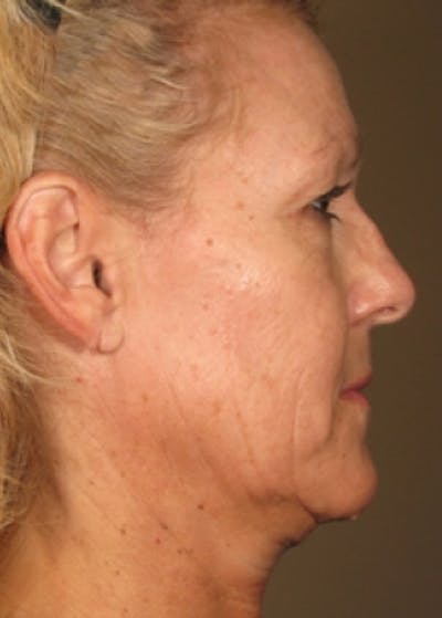 Ultherapy Gallery - Patient 5884043 - Image 1