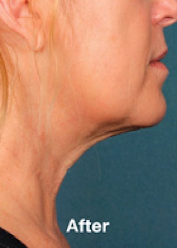 Kybella Before & After Gallery - Patient 5884040 - Image 2