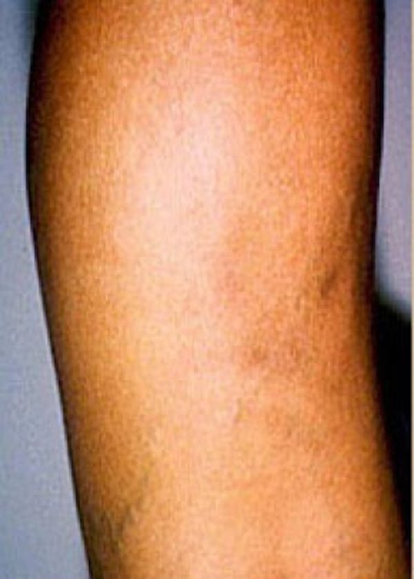 Spider Vein Removal Before & After Gallery - Patient 5884042 - Image 2