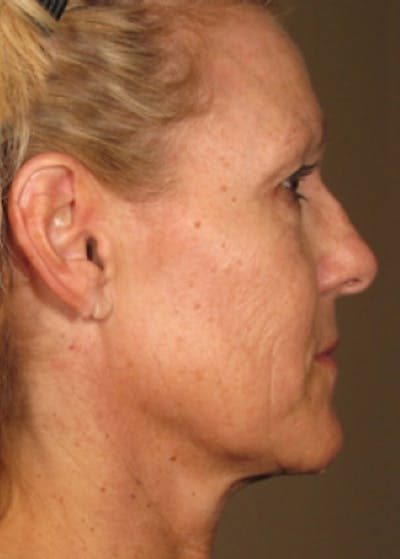 Ultherapy Before & After Gallery - Patient 5884043 - Image 2