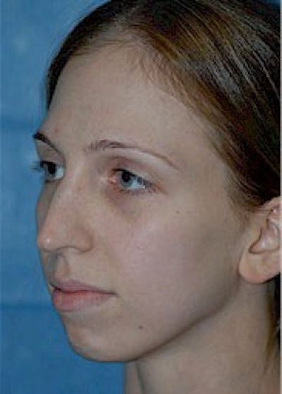 Rhinoplasty Before & After Gallery - Patient 5884045 - Image 1