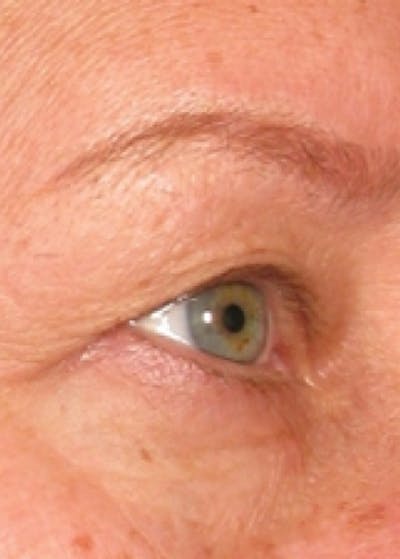 Ultherapy Before & After Gallery - Patient 5884046 - Image 1