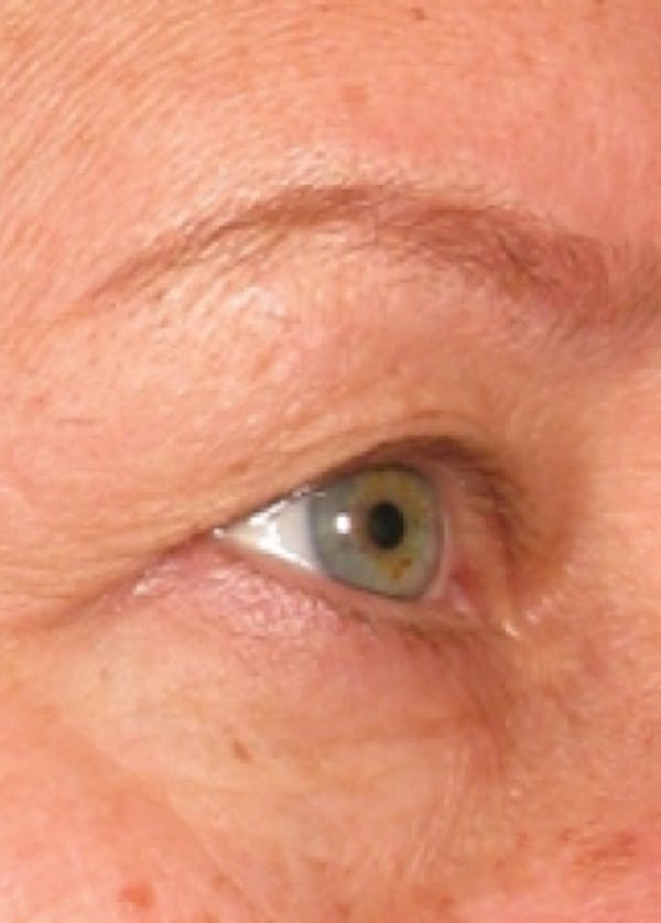 Ultherapy Before & After Gallery - Patient 5884046 - Image 1