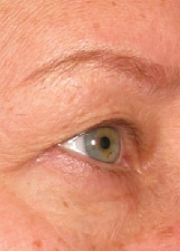 Ultherapy Before & After Gallery - Patient 5884046 - Image 1