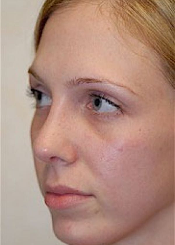 Rhinoplasty Before & After Gallery - Patient 5884045 - Image 2