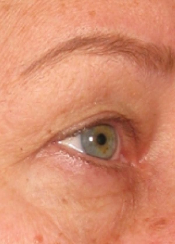 Ultherapy Before & After Gallery - Patient 5884046 - Image 2