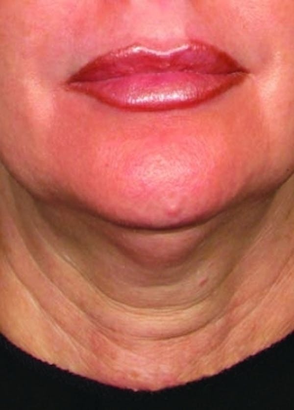 Ultherapy Before & After Gallery - Patient 5884048 - Image 1