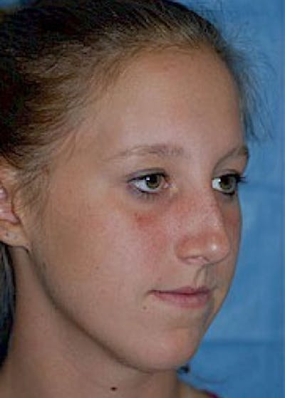 Rhinoplasty Before & After Gallery - Patient 5884049 - Image 1