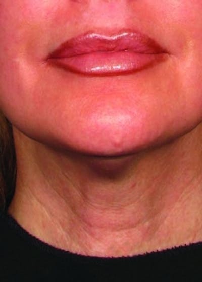 Ultherapy Before & After Gallery - Patient 5884048 - Image 2