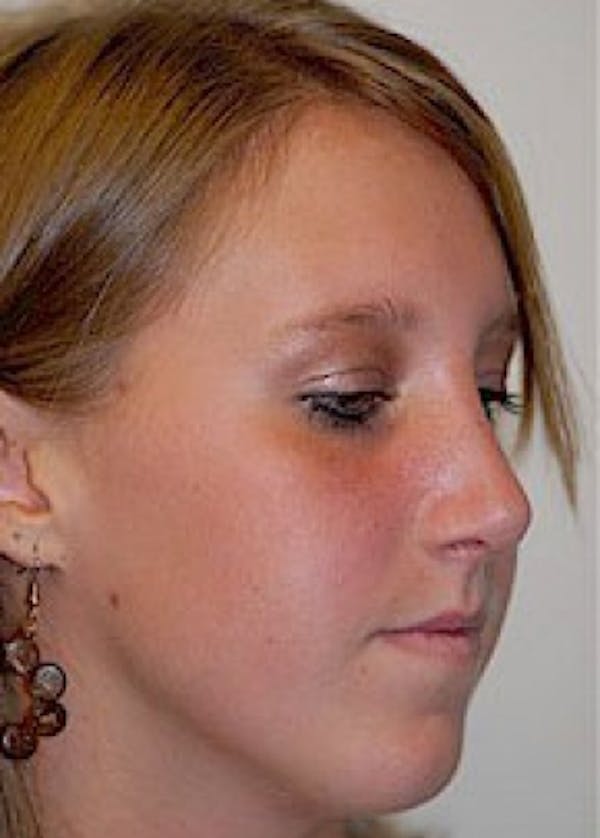 Rhinoplasty Before & After Gallery - Patient 5884049 - Image 2