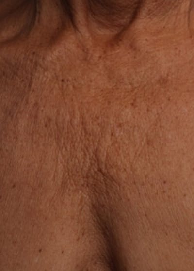 Ultherapy Before & After Gallery - Patient 5884050 - Image 1