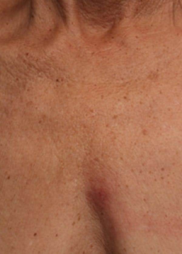Ultherapy Before & After Gallery - Patient 5884050 - Image 2