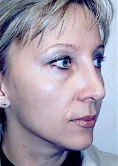 Rhinoplasty Before & After Gallery - Patient 5884051 - Image 2
