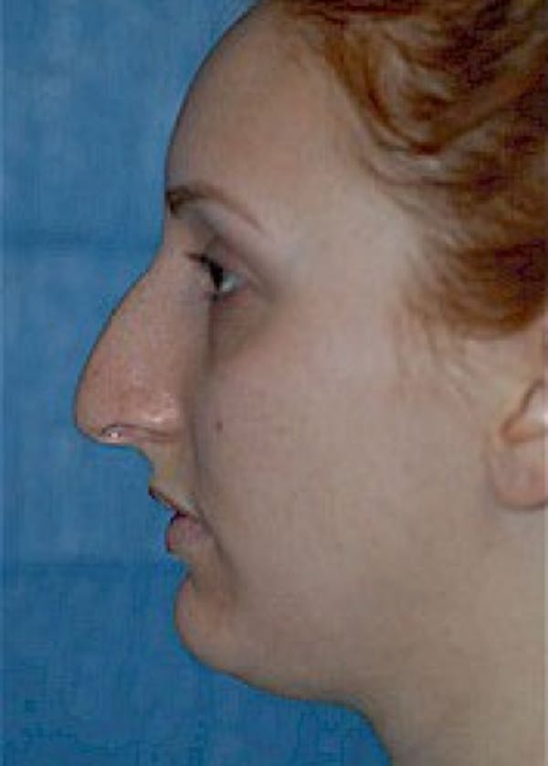 Rhinoplasty Before & After Gallery - Patient 5884054 - Image 3