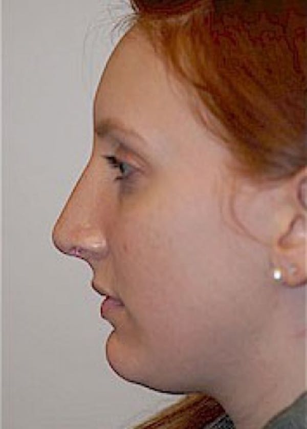 Rhinoplasty Before & After Gallery - Patient 5884054 - Image 4