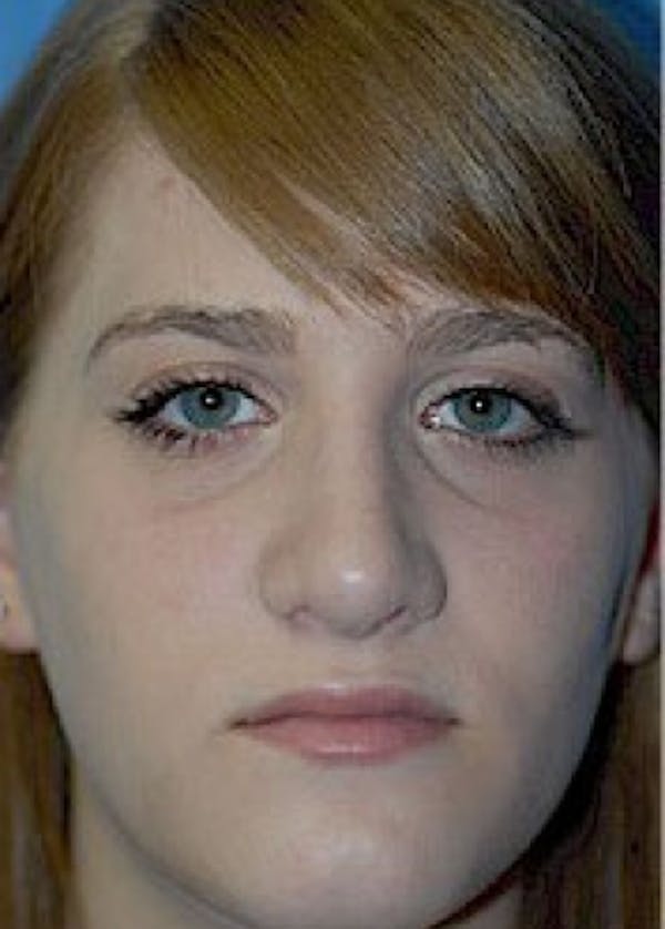 Rhinoplasty Before & After Gallery - Patient 5884056 - Image 2