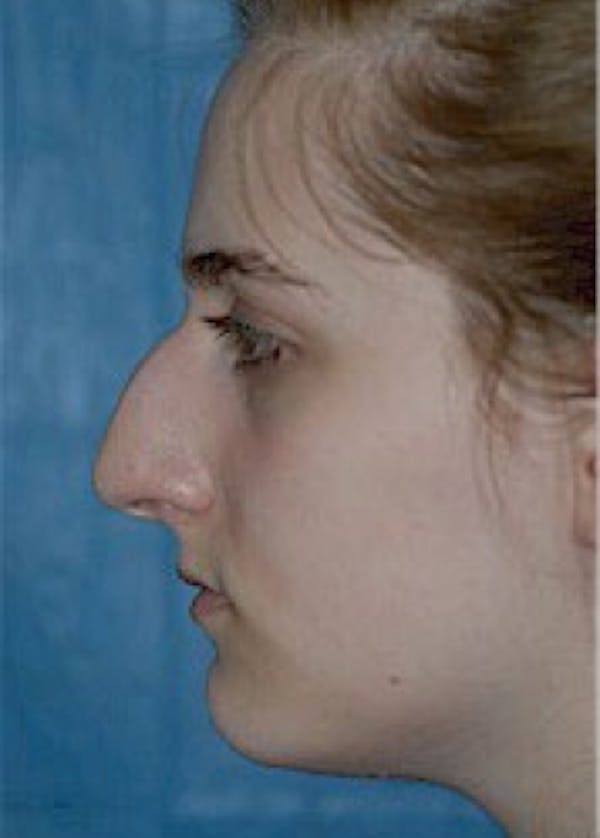 Rhinoplasty Before & After Gallery - Patient 5884056 - Image 3