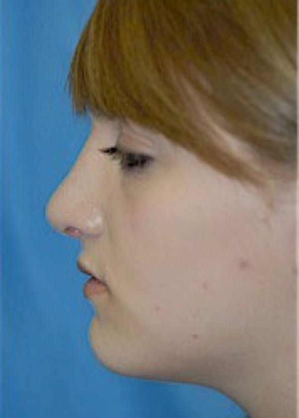 Rhinoplasty Before & After Gallery - Patient 5884056 - Image 4