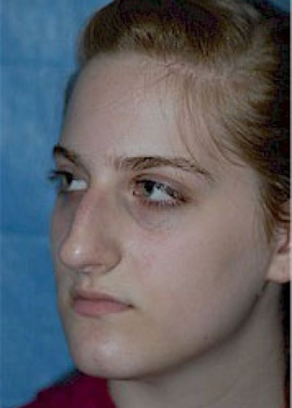 Rhinoplasty Before & After Gallery - Patient 5884056 - Image 5