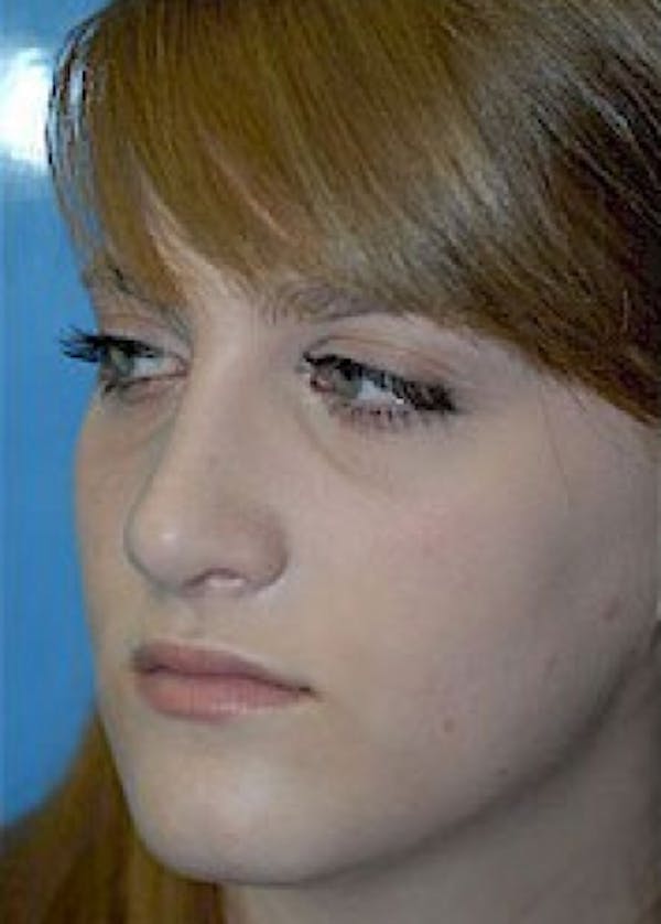 Rhinoplasty Before & After Gallery - Patient 5884056 - Image 6