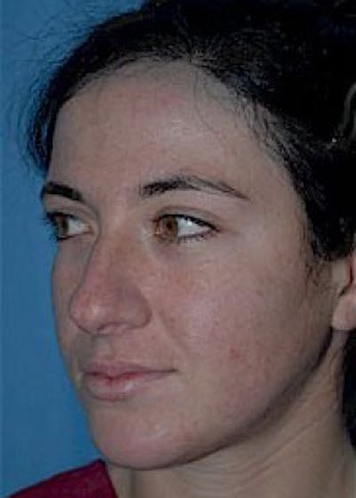 Rhinoplasty Before & After Gallery - Patient 5884059 - Image 1