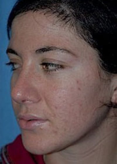 Rhinoplasty Before & After Gallery - Patient 5884059 - Image 2