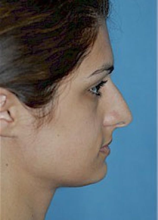 Rhinoplasty Before & After Gallery - Patient 5884062 - Image 1