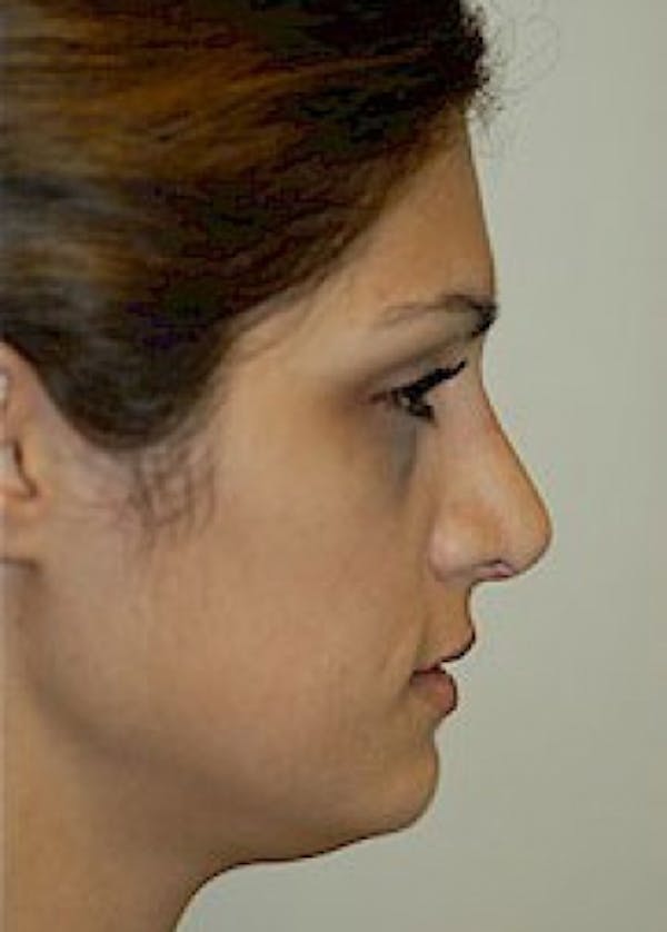Rhinoplasty Before & After Gallery - Patient 5884062 - Image 2