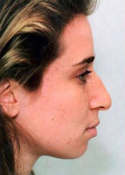 Rhinoplasty Before & After Gallery - Patient 5884063 - Image 1
