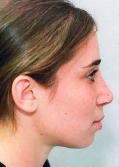 Rhinoplasty Before & After Gallery - Patient 5884063 - Image 2