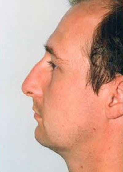 Rhinoplasty Before & After Gallery - Patient 5884065 - Image 1