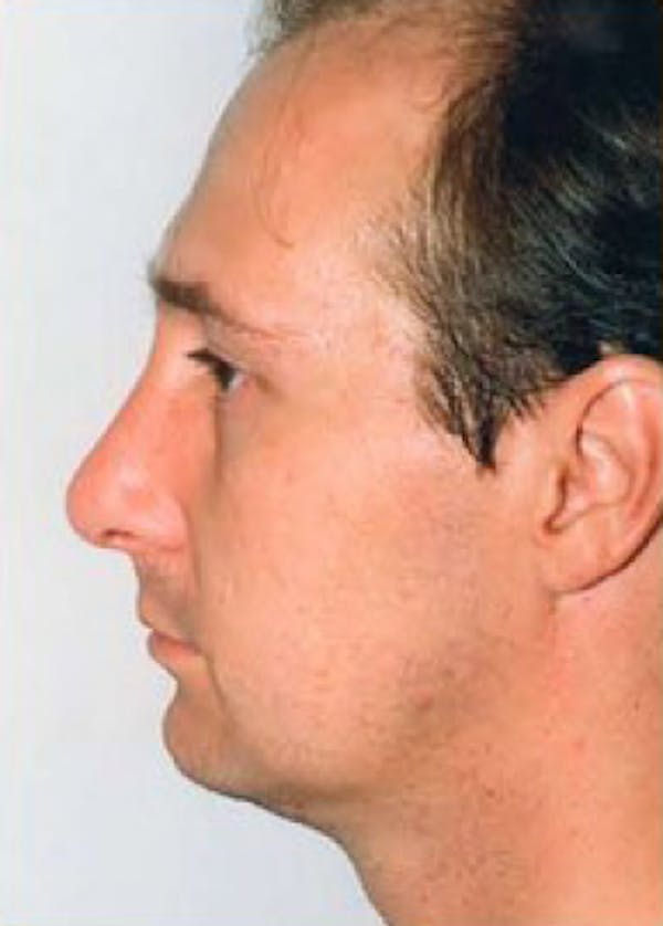 Rhinoplasty Before & After Gallery - Patient 5884065 - Image 2