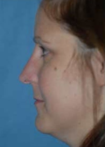 Rhinoplasty Before & After Gallery - Patient 5884067 - Image 1