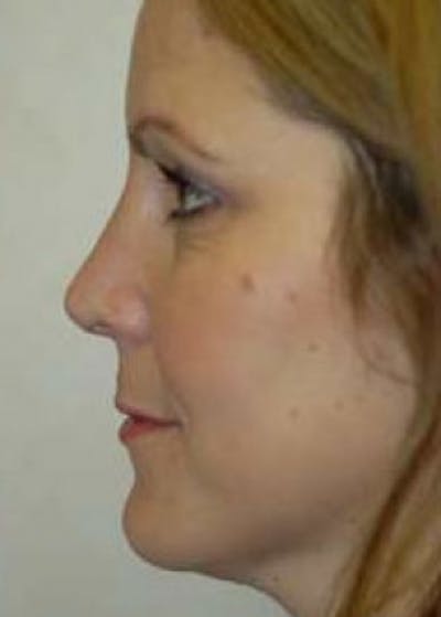 Rhinoplasty Before & After Gallery - Patient 5884067 - Image 2