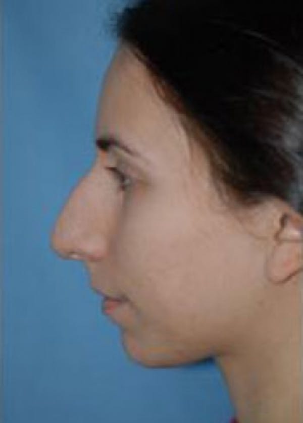Rhinoplasty Before & After Gallery - Patient 5884069 - Image 1