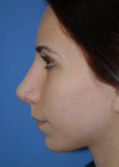Rhinoplasty Before & After Gallery - Patient 5884069 - Image 2