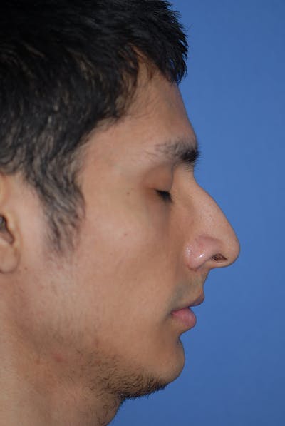 Rhinoplasty Before & After Gallery - Patient 5884070 - Image 1