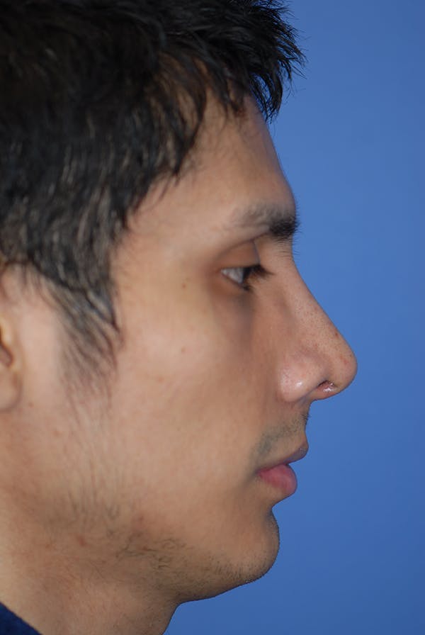 Rhinoplasty Before & After Gallery - Patient 5884070 - Image 2