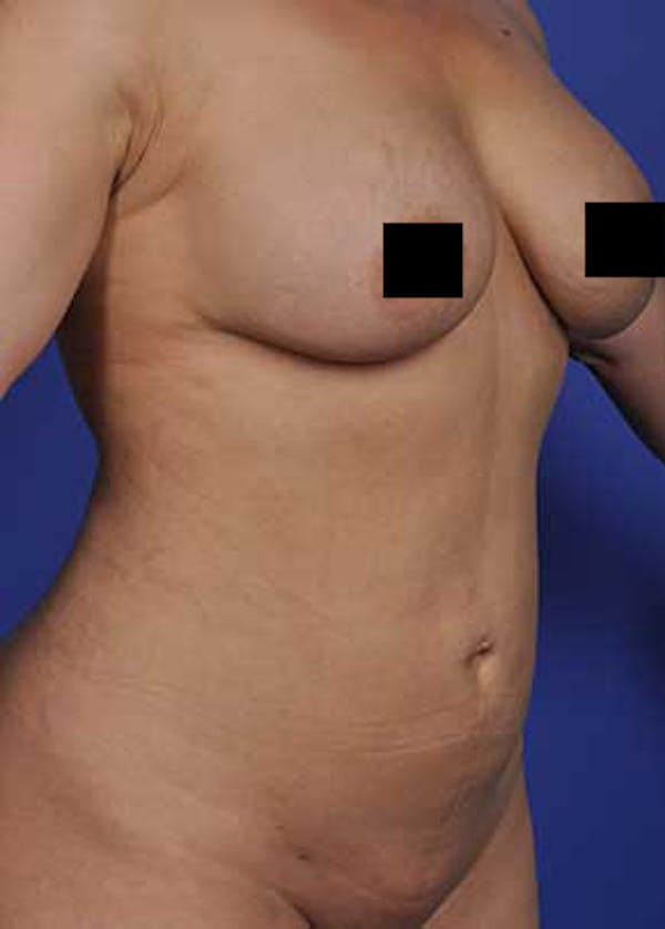 Liposuction and Smartlipo Gallery - Patient 5883288 - Image 2