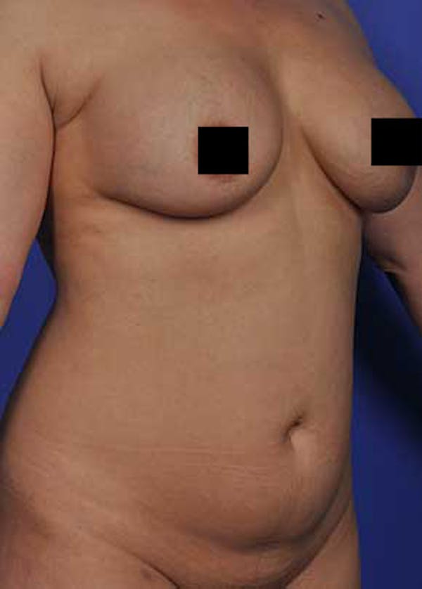 Liposuction and Smartlipo Gallery - Patient 5883288 - Image 1