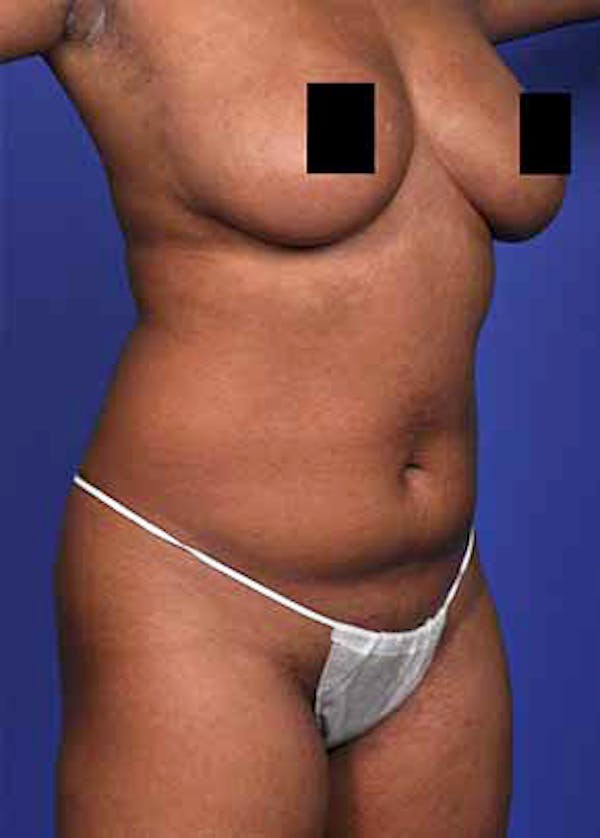 Liposuction and Smartlipo Gallery - Patient 5883292 - Image 1