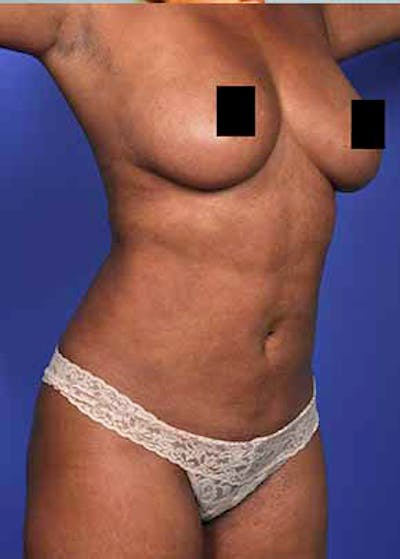 Liposuction and Smartlipo Before & After Gallery - Patient 5883292 - Image 2