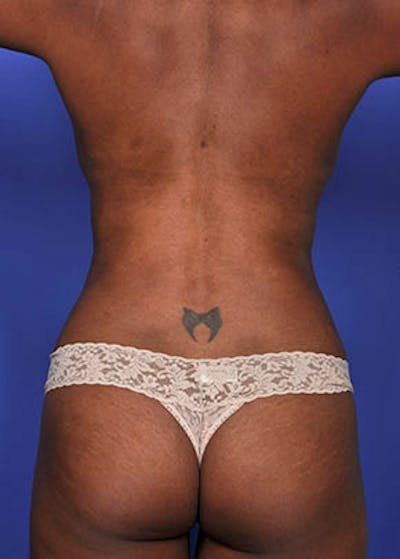 Liposuction and Smartlipo Before & After Gallery - Patient 5883292 - Image 4