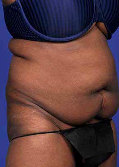 Liposuction and Smartlipo Gallery - Patient 5883273 - Image 1